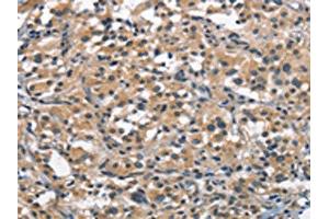 The image on the left is immunohistochemistry of paraffin-embedded Human thyroid cancer tissue using ABIN7189631(ACPT Antibody) at dilution 1/30, on the right is treated with synthetic peptide. (Testicular Acid Phosphatase (ACP4) antibody)