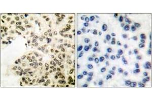Immunohistochemistry analysis of paraffin-embedded human breast carcinoma, using NF-kappaB p65 (Phospho-Ser311) Antibody.