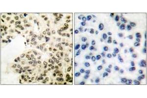 Immunohistochemistry analysis of paraffin-embedded human breast carcinoma, using NF-kappaB p65 (Phospho-Ser311) Antibody. (NF-kB p65 antibody  (pSer311))