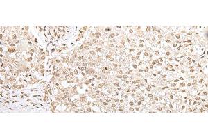 Immunohistochemistry of paraffin-embedded Human lung cancer tissue using ZKSCAN3 Polyclonal Antibody at dilution of 1:50(x200)