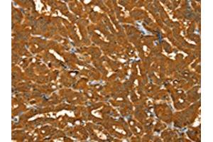 The image on the left is immunohistochemistry of paraffin-embedded Human thyroid cancer tissue using ABIN7130796(PYGM Antibody) at dilution 1/30, on the right is treated with fusion protein. (PYGM antibody)