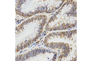 Immunohistochemistry of paraffin-embedded human rectal cancer using TPM2 antibody (ABIN5971583) at dilution of 1/200 (40x lens). (TPM2 antibody)