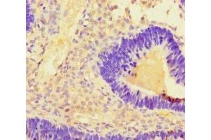 Immunohistochemistry of paraffin-embedded human ovarian cancer using ABIN7173135 at dilution of 1:100 (TMEM27 antibody  (AA 73-146))