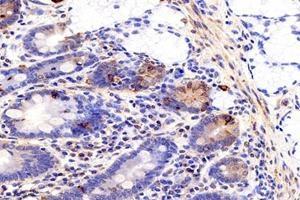 Immunohistochemistry analysis of paraffin-embedded human colon cancer using MIIP (ABIN7074626) at dilution of 1: 1200 (MIIP antibody)