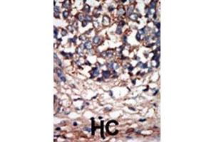 Formalin-fixed and paraffin-embedded human cancer tissue reacted with the primary antibody, which was peroxidase-conjugated to the secondary antibody, followed by AEC staining. (NEK9 antibody  (C-Term))