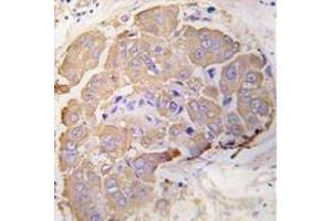 Formalin-fixed and paraffin-embedded human breast carcinoma tissue reacted with HSPB1 Antibody , which was peroxidase-conjugated to the secondary antibody, followed by DAB staining.