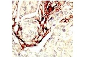 IHC analysis of FFPE human breast carcinoma tissue stained with the LKB1 antibody (LKB1 antibody  (AA 14-44))