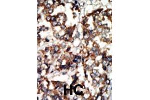 Formalin-fixed and paraffin-embedded human cancer tissue reacted with the primary antibody, which was peroxidase-conjugated to the secondary antibody, followed by DAB staining. (ATM antibody  (N-Term))