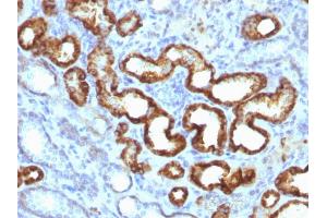 Formalin-fixed, paraffin-embedded human prostate carcinoma (20X) stained with AMACR / p504S Rabbit Monoclonal Antibody (13H4) (AMACR antibody)