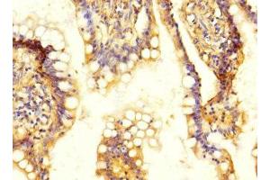 Immunohistochemistry of paraffin-embedded human colon cancer using ABIN7170096 at dilution of 1:100 (SLC13A2 antibody  (AA 345-455))