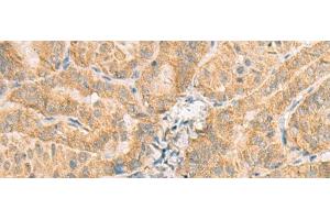 Immunohistochemistry of paraffin-embedded Human thyroid cancer tissue using NCOA4 Polyclonal Antibody at dilution of 1:130(x200) (NCOA4 antibody)