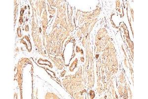 IHC: human leiomyosarcoma stained with Smooth muscle actin antibody (1A4).