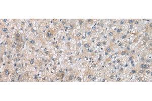 Immunohistochemistry of paraffin-embedded Human liver cancer tissue using PSMF1 Polyclonal Antibody at dilution of 1:30(x200) (PSMF1 antibody)