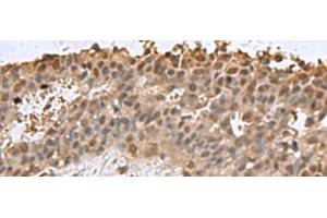 Immunohistochemistry of paraffin-embedded Human breast cancer tissue using DCTPP1 Polyclonal Antibody at dilution of 1:85(x200) (DCTPP1 antibody)