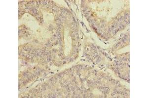 Immunohistochemistry of paraffin-embedded human endometrial cancer using ABIN7163315 at dilution of 1:100 (PLAA antibody  (AA 536-795))