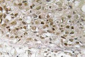 Immunohistochemistry (IHC) analyzes of p-MEK1 antibody in paraffin-embedded human breast carcinoma tissue. (MEK1 antibody  (pThr292))