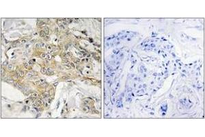 Immunohistochemistry analysis of paraffin-embedded human breast carcinoma tissue, using T4S1 Antibody. (TM4SF1 antibody  (AA 1-50))