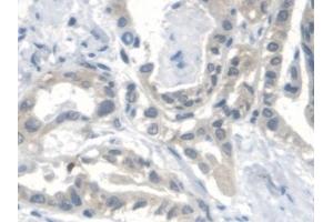 Detection of CTBS in Human Thyroid cancer Tissue using Polyclonal Antibody to Di-N-Acetyl Chitobiase (CTBS) (CTBS antibody  (AA 47-385))