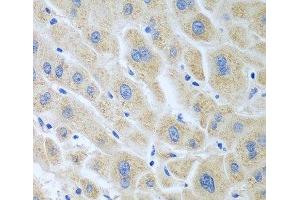 Immunohistochemistry of paraffin-embedded Human liver cancer using BLVRB Polyclonal Antibody at dilution of 1:100 (40x lens). (BLVRB antibody)