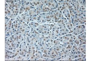 Immunohistochemical staining of paraffin-embedded Carcinoma of kidney tissue using anti-GAD1mouse monoclonal antibody. (GAD antibody)
