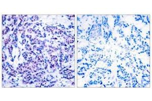 Immunohistochemical analysis of paraffin-embedded human breast carcinoma tissue using JunD(Phospho-Ser255) Antibody(left) or the same antibody preincubated with blocking peptide(right). (JunD antibody  (pSer255))
