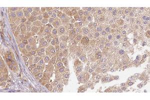 ABIN6272666 at 1/100 staining Human Melanoma tissue by IHC-P. (LTBP1 antibody  (C-Term))