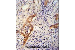 CLPX antibody immunohistochemistry analysis in formalin fixed and paraffin embedded human hepatocarcinoma followed by peroxidase conjugation of the secondary antibody and DAB staining. (CLPX antibody  (C-Term))