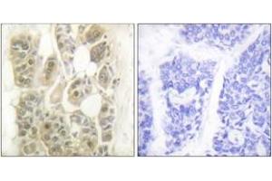 Immunohistochemistry analysis of paraffin-embedded human breast carcinoma tissue, using SSB (Ab-366) Antibody. (SSB antibody  (AA 341-390))