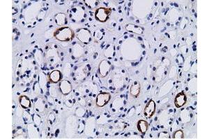 Immunohistochemical staining of paraffin-embedded Human lymphoma tissue using anti-PIK3AP1 mouse monoclonal antibody.