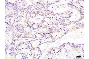 Formalin-fixed and paraffin embedded human rectal carcinoma labeled with Anti-Aldolase A Polyclonal Antibody, Unconjugated (ABIN739800) at 1:200 followed by conjugation to the secondary antibody and DAB staining