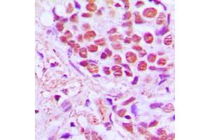 Immunohistochemical analysis of SRSF4 staining in human breast cancer formalin fixed paraffin embedded tissue section. (SRSF4 antibody  (Center))