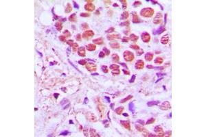 Immunohistochemical analysis of SRSF4 staining in human breast cancer formalin fixed paraffin embedded tissue section.