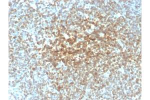 Formalin-fixed, paraffin-embedded human Follicular Lymphoma stained with Bcl-2 Mouse Recombinant Monoclonal Antibody (rBCL2/782).
