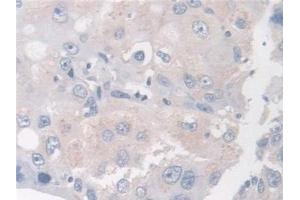 Detection of BCAR1 in Human Breast cancer Tissue using Polyclonal Antibody to Breast Cancer Anti-Estrogen Resistance 1 (BCAR1) (BCAR1 antibody  (AA 1-240))