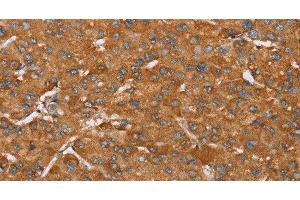 Immunohistochemistry of paraffin-embedded Human liver cancer tissue using PAGE5 Polyclonal Antibody at dilution 1:55 (PAGE5 antibody)