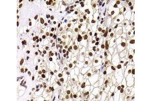 Immunohistochemistry of paraffin-embedded Human kidney cancer using PHIP Polyclonal Antibody at dilution of 1:100 (40x lens).