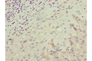 Immunohistochemistry of paraffin-embedded human liver cancer using ABIN7162175 at dilution of 1:100 (OR2H1 antibody  (AA 157-193))