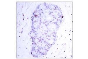 Immunohistochemical analysis of paraffin-embedded human breast carcinoma tissue using NF-κB p105/p50 (phospho-Ser907) antibody (E011019). (NFKB1 antibody  (pSer907))