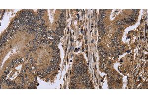 Immunohistochemistry of paraffin-embedded Human colon cancer using EIF3H Polyclonal Antibody at dilution of 1:50 (EIF3H antibody)
