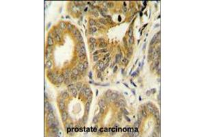 ARL8A Antibody immunohistochemistry analysis in formalin fixed and paraffin embedded human prostate carcinoma followed by peroxidase conjugation of the secondary antibody and DAB staining. (ARL8A antibody  (AA 116-142))
