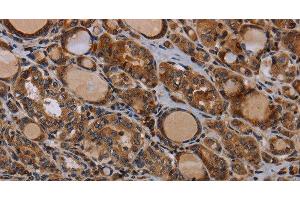 Immunohistochemistry of paraffin-embedded Human thyroid cancer using PAPPA Polyclonal Antibody at dilution of 1:50 (PAPPA antibody)