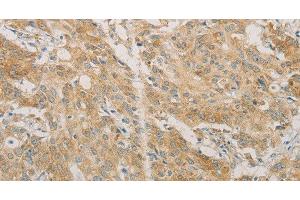 Immunohistochemistry of paraffin-embedded Human gastric cancer using ACSL4 Polyclonal Antibody at dilution of 1:60 (ACSL4 antibody)