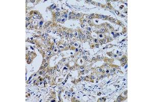 Immunohistochemistry of paraffin-embedded human colon carcinoma using TPPP3 antibody. (TPPP3 antibody  (AA 1-176))