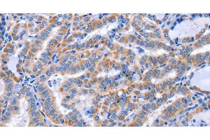 Immunohistochemistry of paraffin-embedded Human thyroid cancer using CCR6 Polyclonal Antibody at dilution of 1:50 (CCR6 antibody)