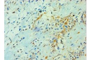 Immunohistochemistry of paraffin-embedded human breast cancer using ABIN7142103 at dilution of 1:100 (14-3-3 theta antibody  (AA 1-245))