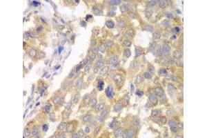 Immunohistochemistry of paraffin-embedded Human esophageal cancer using PFKM Polyclonal Antibody at dilution of 1:100 (40x lens). (PFKM antibody)