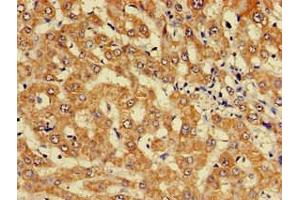 Immunohistochemistry of paraffin-embedded human liver cancer using ABIN7157603 at dilution of 1:100 (KIF17 antibody  (AA 500-777))