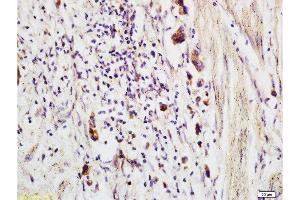 Formalin-fixed and paraffin embedded human colon carcinoma labeled with Anti-CCP Polyclonal Antibody, Unconjugated  at 1:200 followed by conjugation to the secondary antibody and DAB staining (CRYGD antibody)