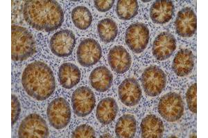 Immunohistochemistry of paraffin-embedded sections (colorectal adenocarcinoma) Immunohistochemistry staining of colorectal adenocarcinoma (paraffin-embedded sections) with anti-human Blood Group Lewis a (7LE). (Blood Group Lewis A antibody)