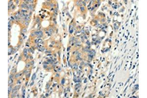 The image on the left is immunohistochemistry of paraffin-embedded Human colon cancer tissue using ABIN7130917(RPAP3 Antibody) at dilution 1/15, on the right is treated with fusion protein. (RPAP3 antibody)